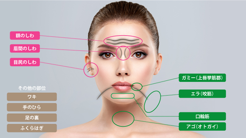 ボツリヌストキシン注射部位